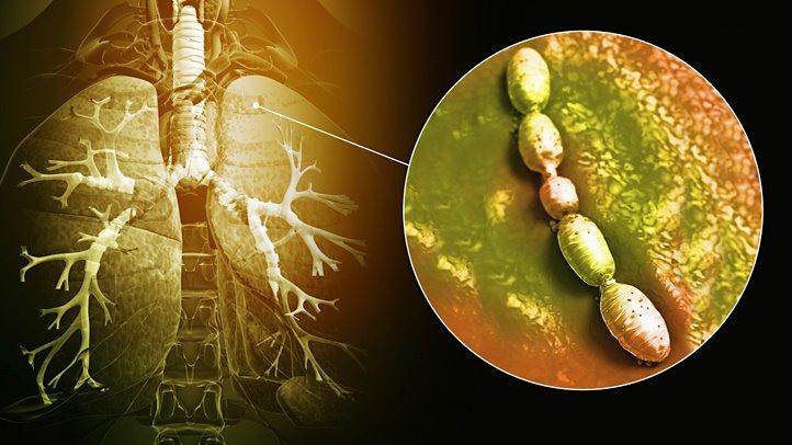 Бактерии – причина опасной бактериальной пневмонии