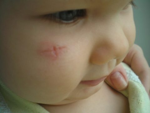 Иногда на теле малыша, после травмирования животными, остаются заметные рубцы