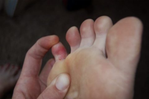 Интенсивность болезненных ощущений при травме мизинца на ноге