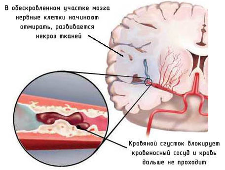 инсульт мозга