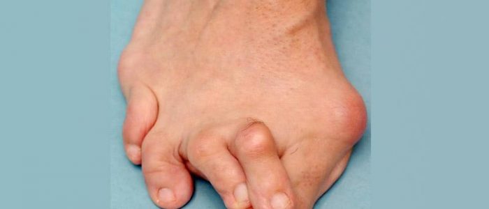Молоткообразный палец на ноге