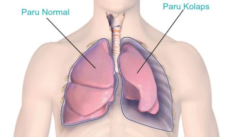 Искусственным пневмотораксом обездвиживают лёгкое