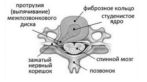 Протрузия диска шейного отдела позвоночника