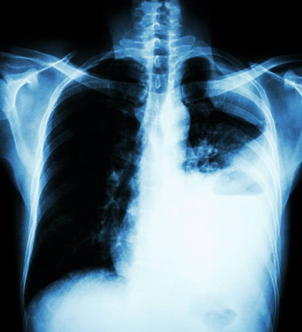Как выглядит рак легких на снимке рентгенограммы.