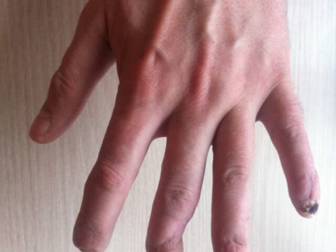 Классификация видов переломов пальцев