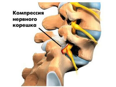 Компрессия нервного корешка при остеохондрозе