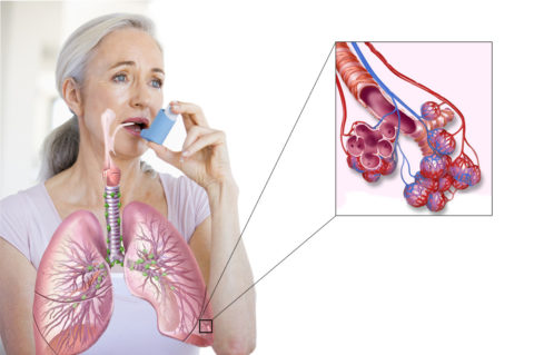Купирование приступа астмы при помощи ингалятора