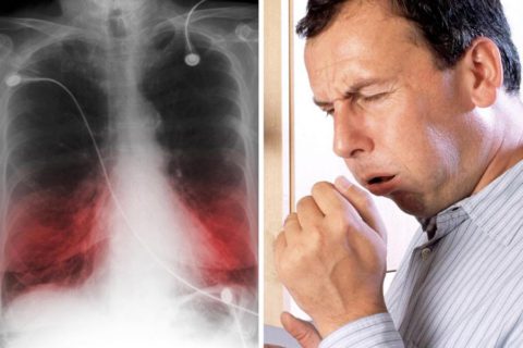 Курение при пневмонии препятствует отхождению мокроты