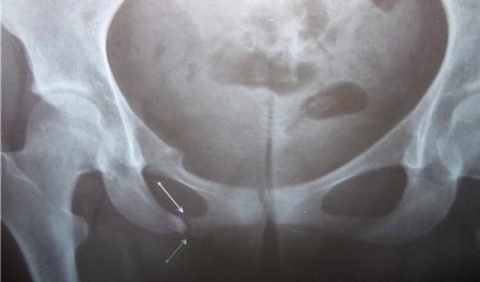 Линия излома на рентгеновском диагностическом снимке в одной из двух проекций