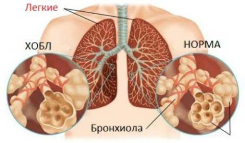 Люди с ХОЗЛ значительно чаще болеют пневмониями
