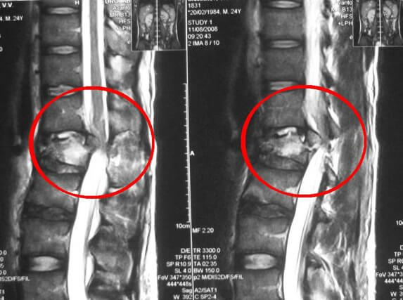 Снимок магнитно-резонансная томография грудного остеохондроза