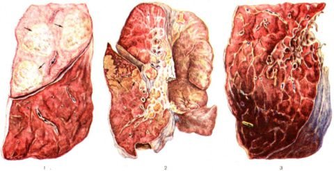 Макропрепарат лёгкого при пневмонии, вызванной палочкой Фридлендера, на разных стадиях заболевания
