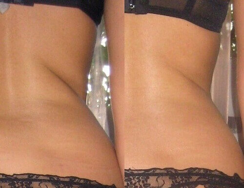 медовый массаж отзывы фото до и после