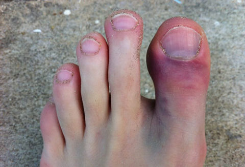 Механизмы возникновения травмы пальцев на ногах