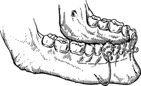 Метод фиксирования отломков с крючком часто используют при отсутствии зубов.