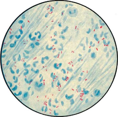 Микобактерии туберкулеза (на фото – красного цвета) хорошо видны при микроскопии окрашенных мазков мокроты