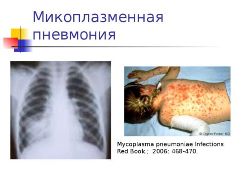 Микоплазменная пневмония