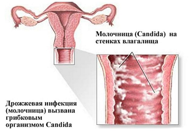 Инфецирование молочницей у женщин