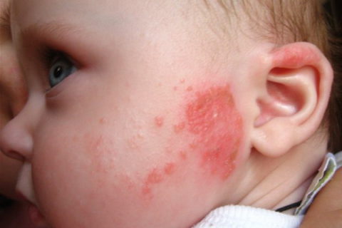 На фото аллергический бронхит у ребенка с кожными проявлениями в виде сыпи.