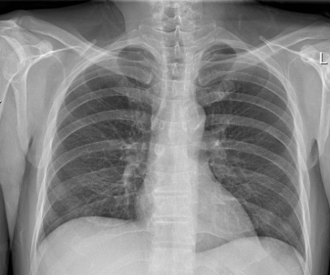 На фото рентген пациента с двусторонней пневмонией.