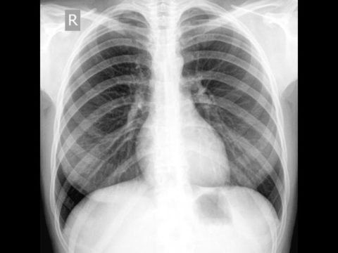На фото рентген пациента с бронхитом