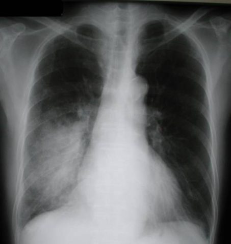 На фото рентгеновских снимок, на котором легкие с воспалением.