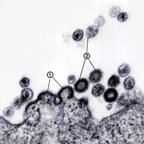 На фото видно, как респираторные вирусы атакуют здоровые клетки