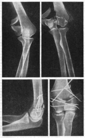 На рентгенограмме переломы мыщелков плечевой кости
