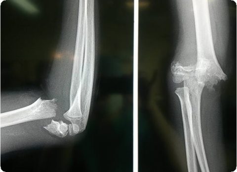 На рентгенограмме видны диафизарные переломы плечевой кости
