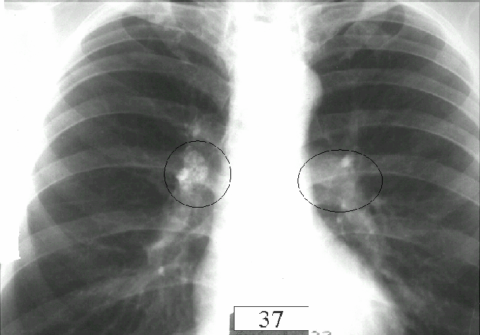 На рентгеновском снимке кругами показан туберкулезный бронхоаденит