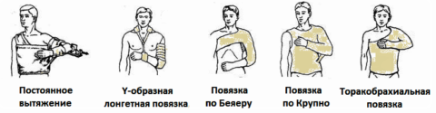 Некоторые из видов иммобилизации после переломов кости плеча
