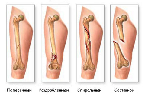 Некоторые виды переломов тела бедренной кости