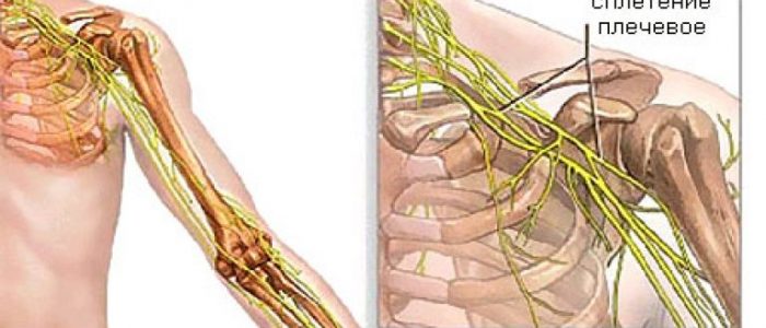Невралгия плечевого нерва