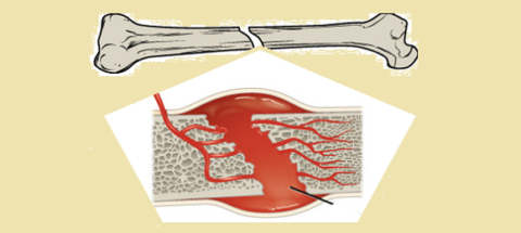 Образование при переломе гематомы запускает процесс регенерации костной ткани