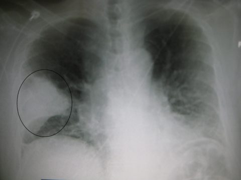 Очаговая правосторонняя пневмония у ребенка на рентгенограмме