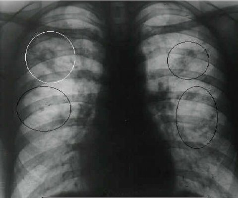 Очаговый туберкулез легких на рентгеногграмме