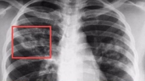 Очаговый туберкулез на рентгенограмме имеет очаги отсева и дорожку к корням легкого