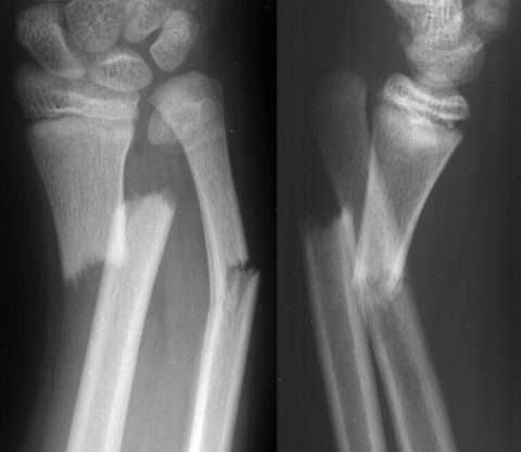 Определение смещенных костных отломков на рентгенографическом снимке