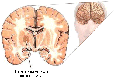 Рак головного мозга