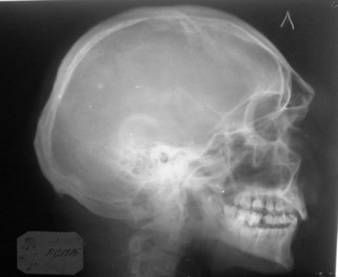 Оскольчатый открытый перелом костей носа