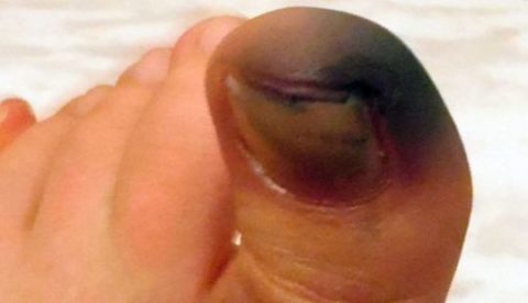 Осложнение перелома пальца в форме развивающейся гангрены
