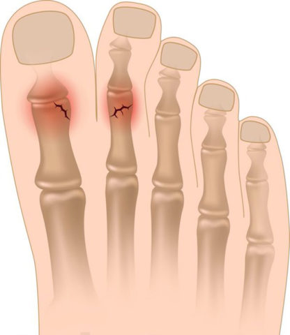 Особенности перелома фаланг пальцев на ноге