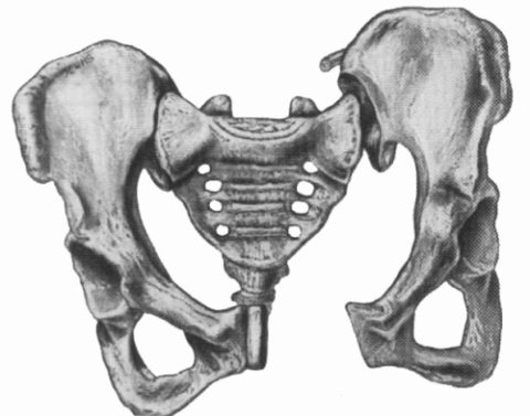 Особенности сломанных тазовых костей в тяжелой форме