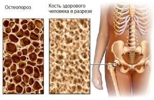 Артрит и остеопороз