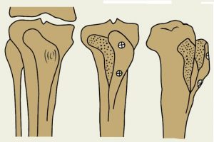 Остеотомия сустава колена