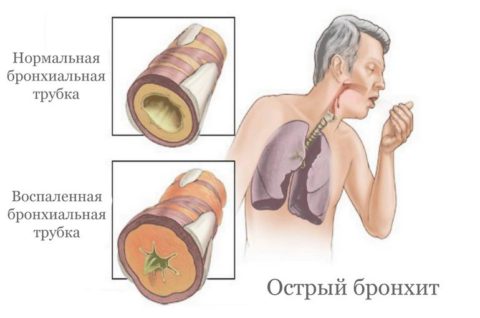 Острое заболевание верхних отделов дыхательной системы - бронхит