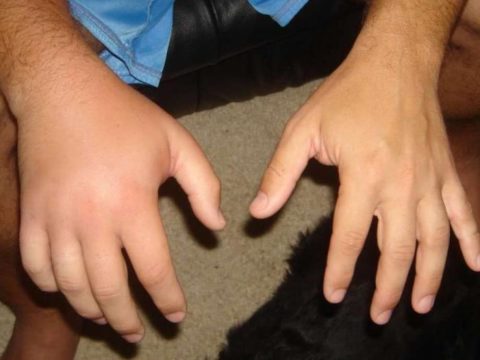 Отечность руки после повреждения целостности структурной ткани