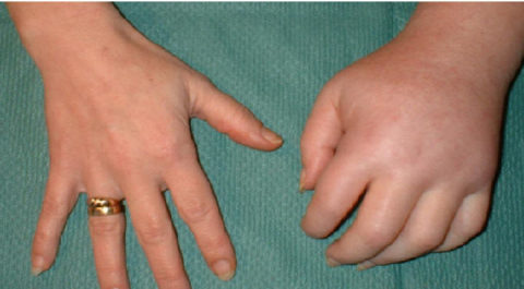 Отечность руки также является вариантом нормы после снятия гипсовой повязки.
