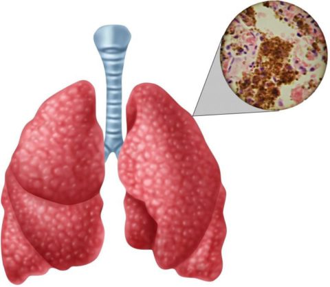 Открытая форма туберкулеза