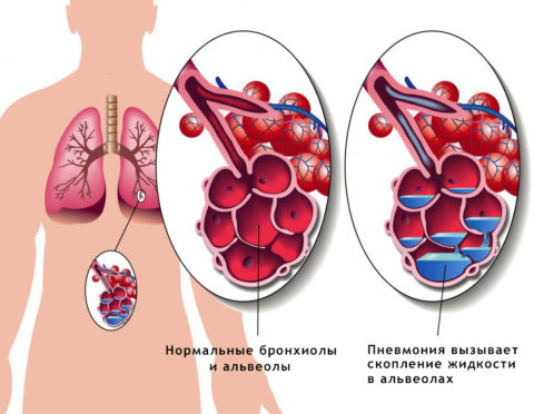 Патогенез пневмонии